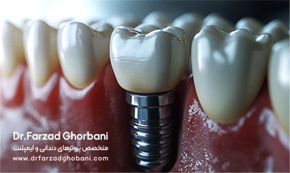 چرا ایمپلنت دندانی بهترین راهکار برای جایگزینی دندان‌های از دست‌رفته است؟