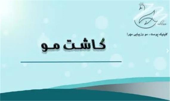 راز جوانی با کاشت مو در کلینیک مهرا {صفر تا صد}