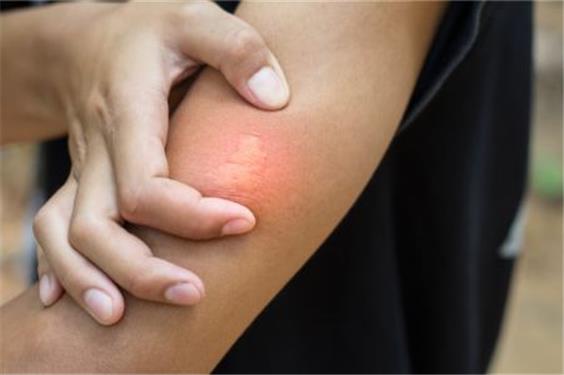 آلرژی به نیش حشرات چیست و چه علائمی را در فرد ایجاد می‌کند؟