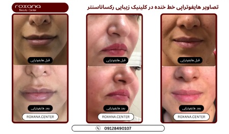 جوانسازی صورت با ۶ روش بدون جراحی