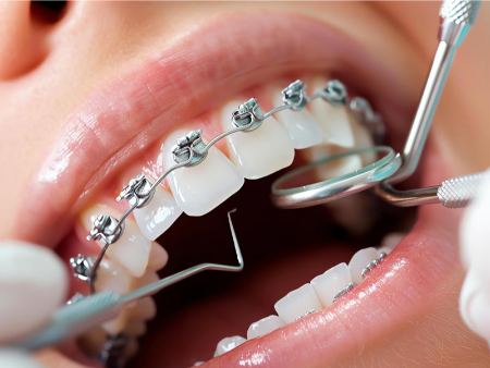 ارتودنسی فقط برای زیبایی نیست؛ نگاهی به فواید پنهان آن