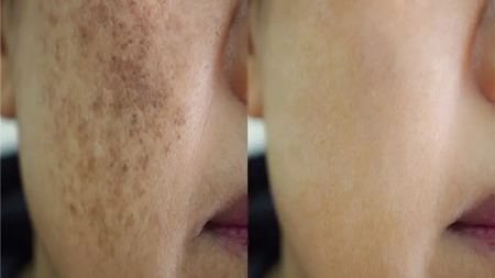 اسید تراپی پوست برای لک و جای جوش