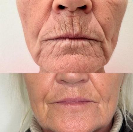 فیلر لب بهتر است یا بوتاکس؟ مقایسه کامل دو روش محبوب