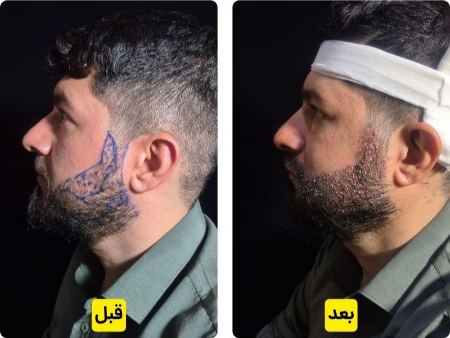 کاشت ریش و سبیل دائمی | بهترین روش در کلینیک آریایی تهران