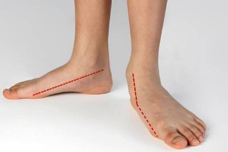 کف پای صاف چگونه باعث انحراف زانو می‌شود؟