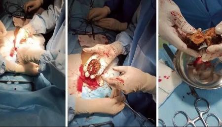 ماجرای ترسناک «خرمالو» در اتاق‌های عمل مشهد